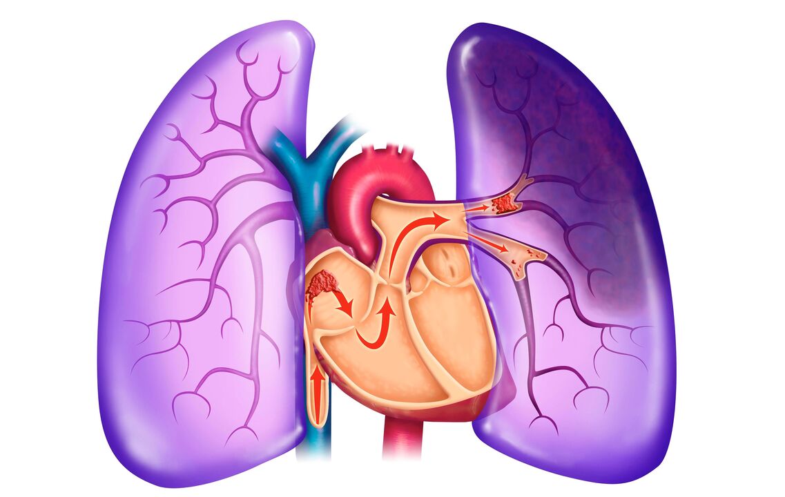 pulmonal Hypertonie